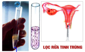 Lọc rửa Tinh Trùng và chọn lọc Tinh Trùng khỏe