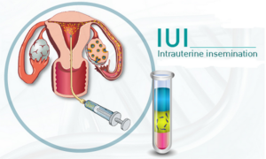 IUI TRỌN GÓI - BƠM TINH TRÙNG IUI
